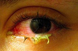 Bệnh đau mắt đỏ