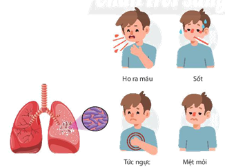 Biểu hiện của người bị bệnh lao phổi